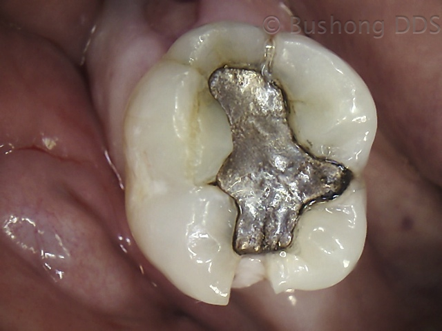 tooth with cavity fillings at Alamo Ranch Dental